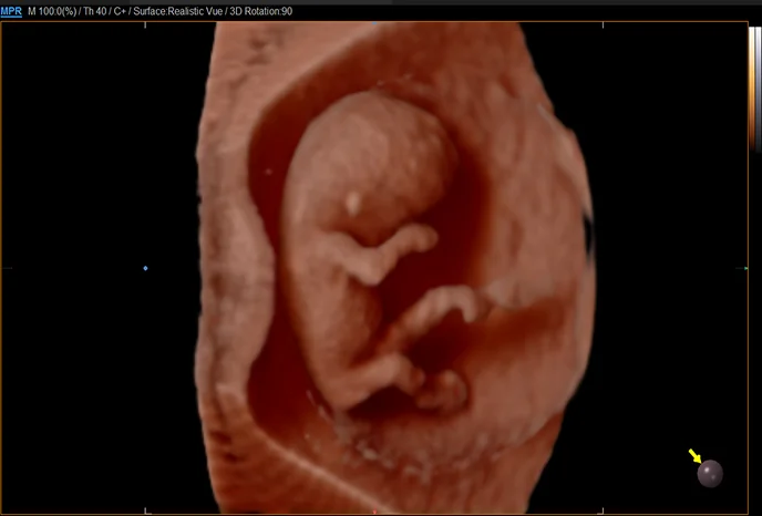 fetus-im-ersten-trimester-mit-realistic-vue