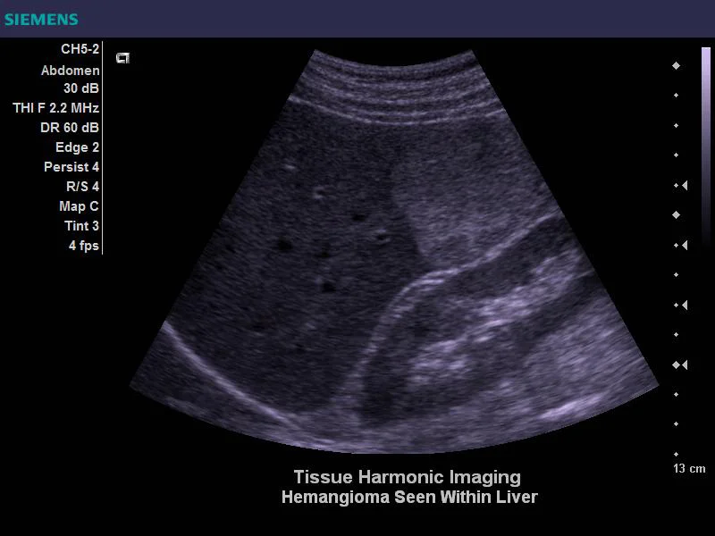 Dieses Bild zeigt, wie Tissue Harmonic Imaging die Kontrastaufl