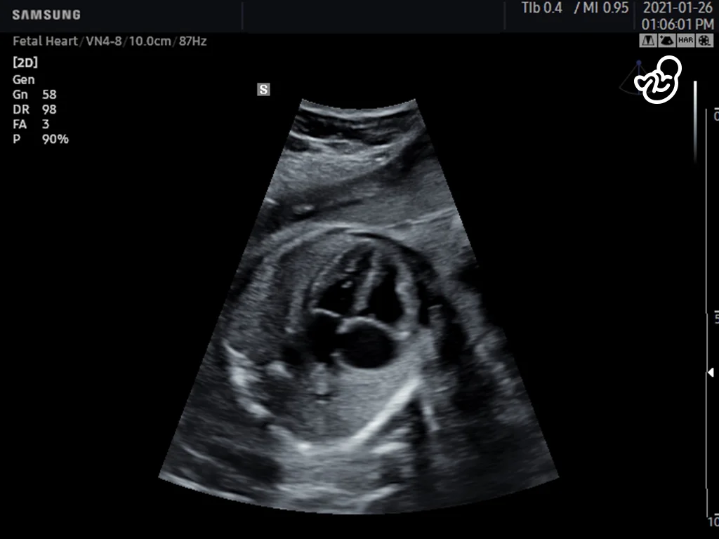 4-Kammerblick des fetalen Herzens