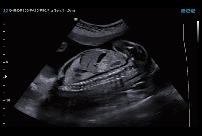 fetales-abdomen-mit-clearvision
