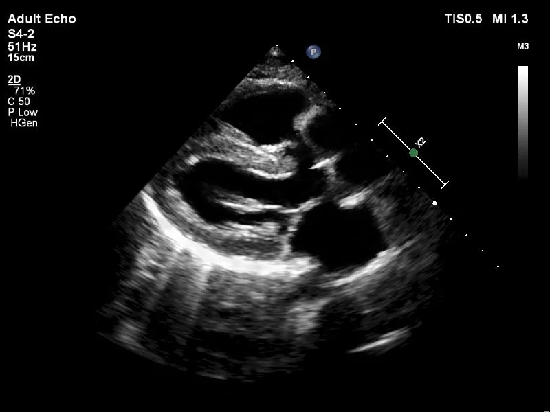 Herz Ultraschallbild