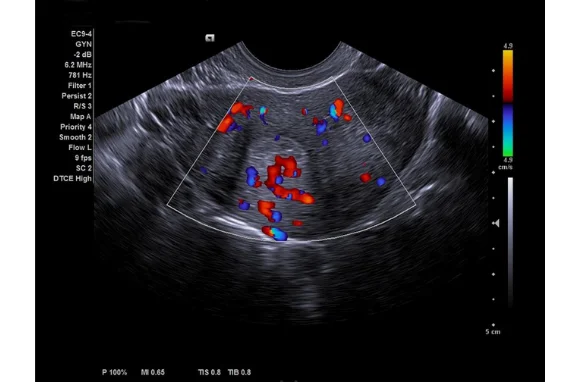 endovaginaler-ultraschall