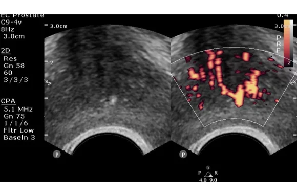 prostata-ultraschall-im-doppelbild-power-mode-angiocompare