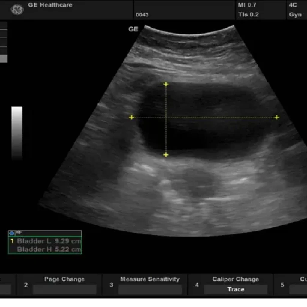 ge-versana-premier-lotus-c6-2 Auto Bladder